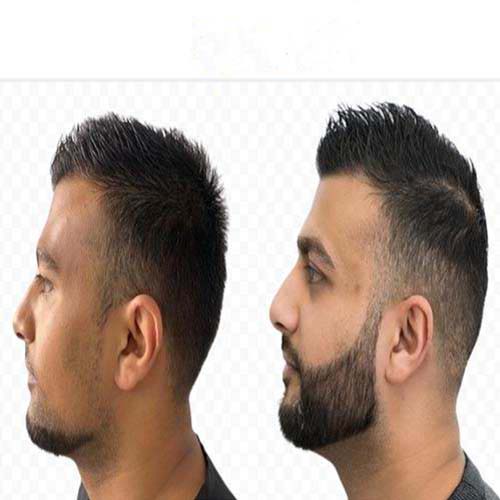 انواع روش های کاشت ریش