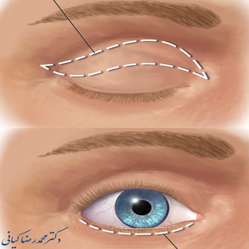 بلفاروپلاستی چیست