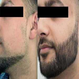 کاشت ریش مناسب چه افرادی است