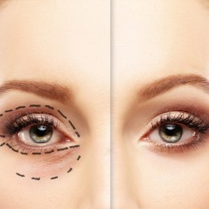 Blepharoplasty