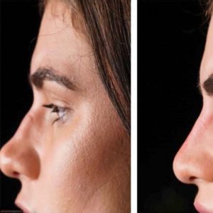 اصلاح فرم بینی با فیلر