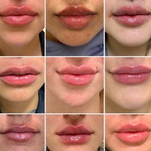 انواع مدل های تزریق ژل لب