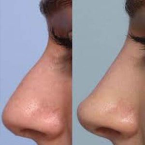 تأثیرات فیلر بینی بر ایجاد ظاهر زیبا