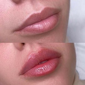 عوارض و مشکلات پس از فیلر لب