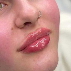 نحوه تزریق و ماندگاری ژل لب روسی
