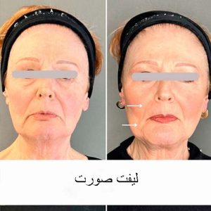 لیفت صورت با نخ چه مزایا و عوارضی دارد؟