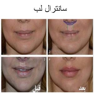 آیا در عمل لیفت سانترال لب بخیه باقی میماند؟