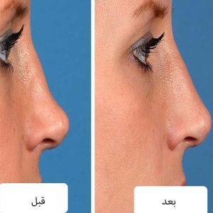 فیلر بینی استخوانی
