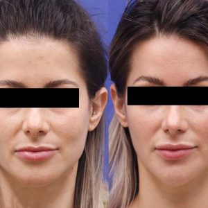 هزینه های مرتبط با عمل لیفت شقیقه