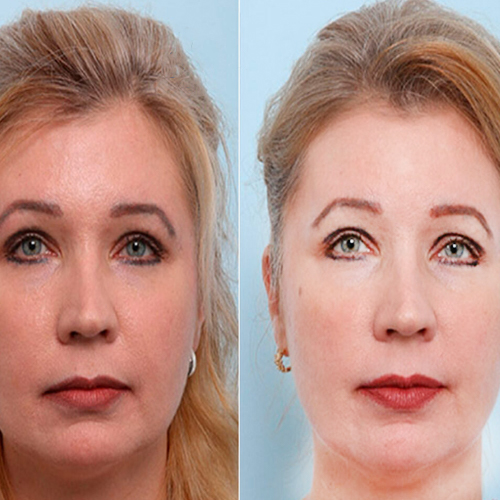 توده چربی بوکال فت باعث پیری میشود