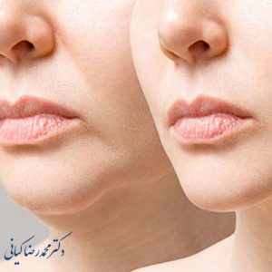 آیا ساکشن غبغب برای همه مناسب است؟