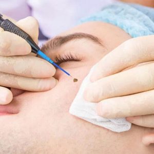 اصول و مراحل برداشت خال پوستی