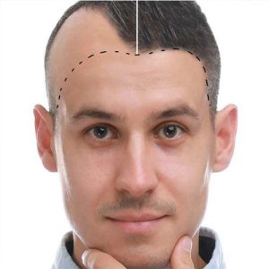 انواع روش های کاشت مو
