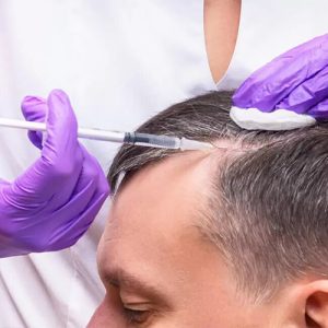 تاثیر تزریق پی آر پی بر ریزش مو