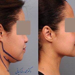 تجربیات بیماران پس از ساکشن غبغب