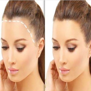 ترمیم موی پیشانی
