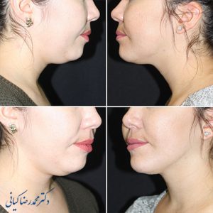 جراحی غبغب 0 تا 100 مزایا و معایب لیپوساکشن