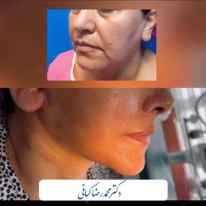 روش ساکشن غبغب