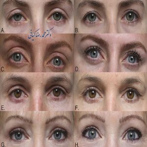 روشهای مختلف بلفاروپلاستی پلک بالا