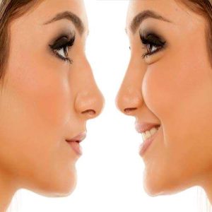 رینوپلاستی مایع