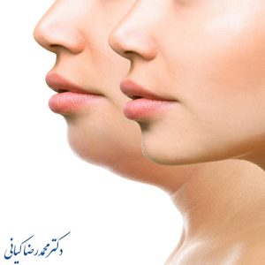 ساکشن غبغب