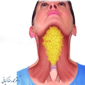 ساکشن غبغب بهترین روش رفع چربی غبغب