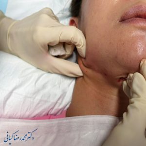 ساکشن غبغب چگونه انجام میشود؟