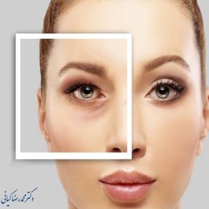 طول درمان بلفاروپلاستی