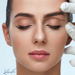 عوارض بلفاروپلاستی پلک بالا