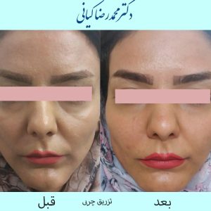 لیفت صورت با تزریق چربی