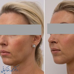 لیپوساکشن غبغب نحوه انجام، ، مزایا، و معایب