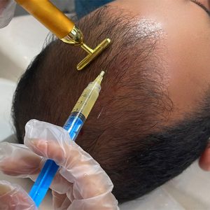ماندگاری تزریق پی آر پی مو سر
