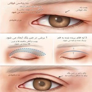 مدت زمان بهبودی پس از بلفاروپلاستی پلک بالا