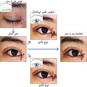 مراحل انجام بلفاروپلاستی پلک بالا