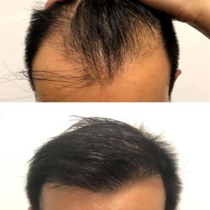 مراحل عمومی کاشت مو