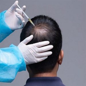 مزایا و معایب تزریق پی آر پی موی سر