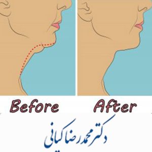 مزایا و معایب ساکشن غبغب