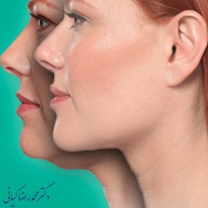 پیشگیری از عوارض پس از ساکشن غبغب