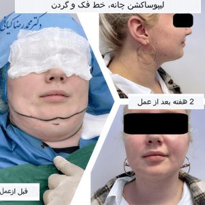 چه زمانی نتایج ساکشن غبغب قابل مشاهده است؟