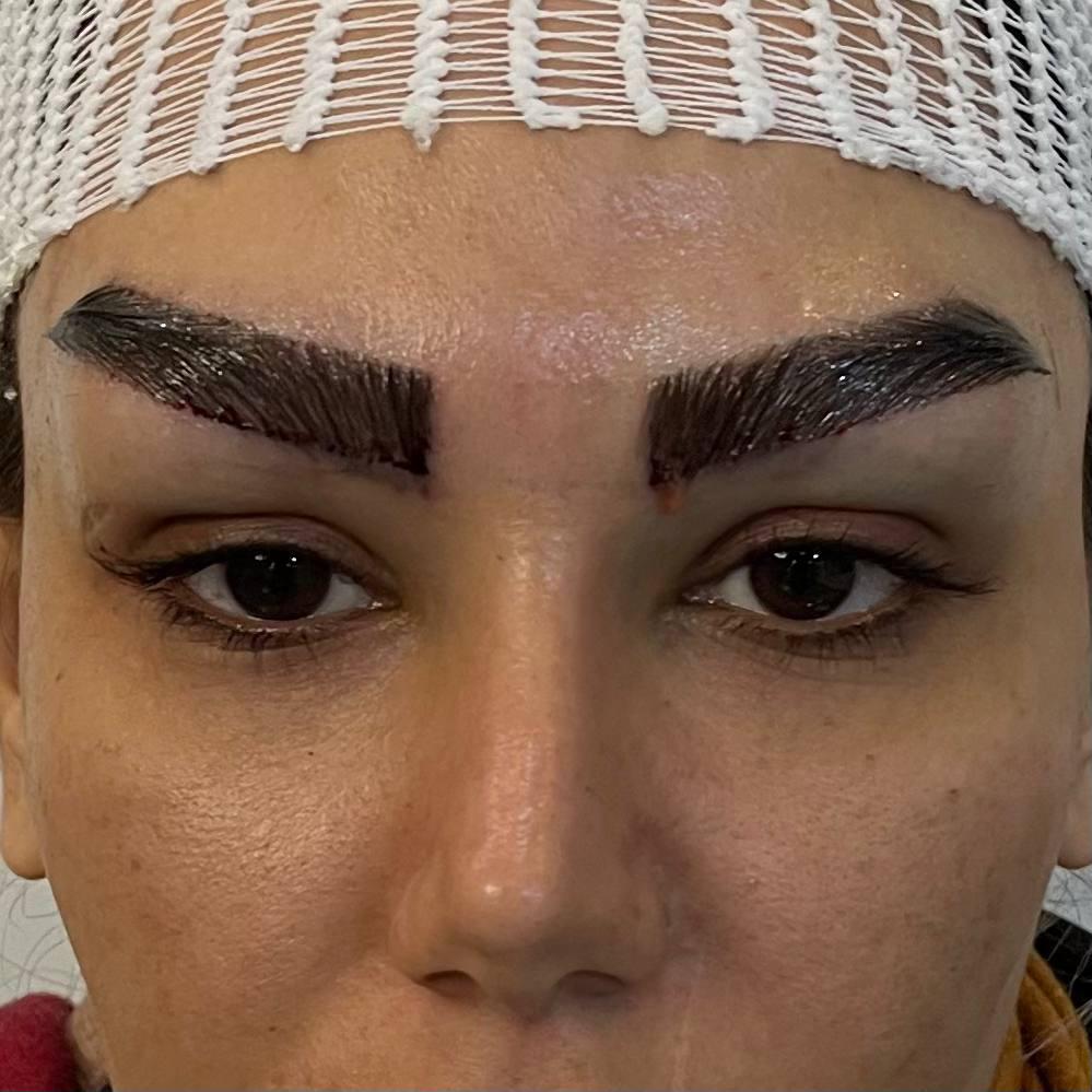 خدمات کاشت ابرو