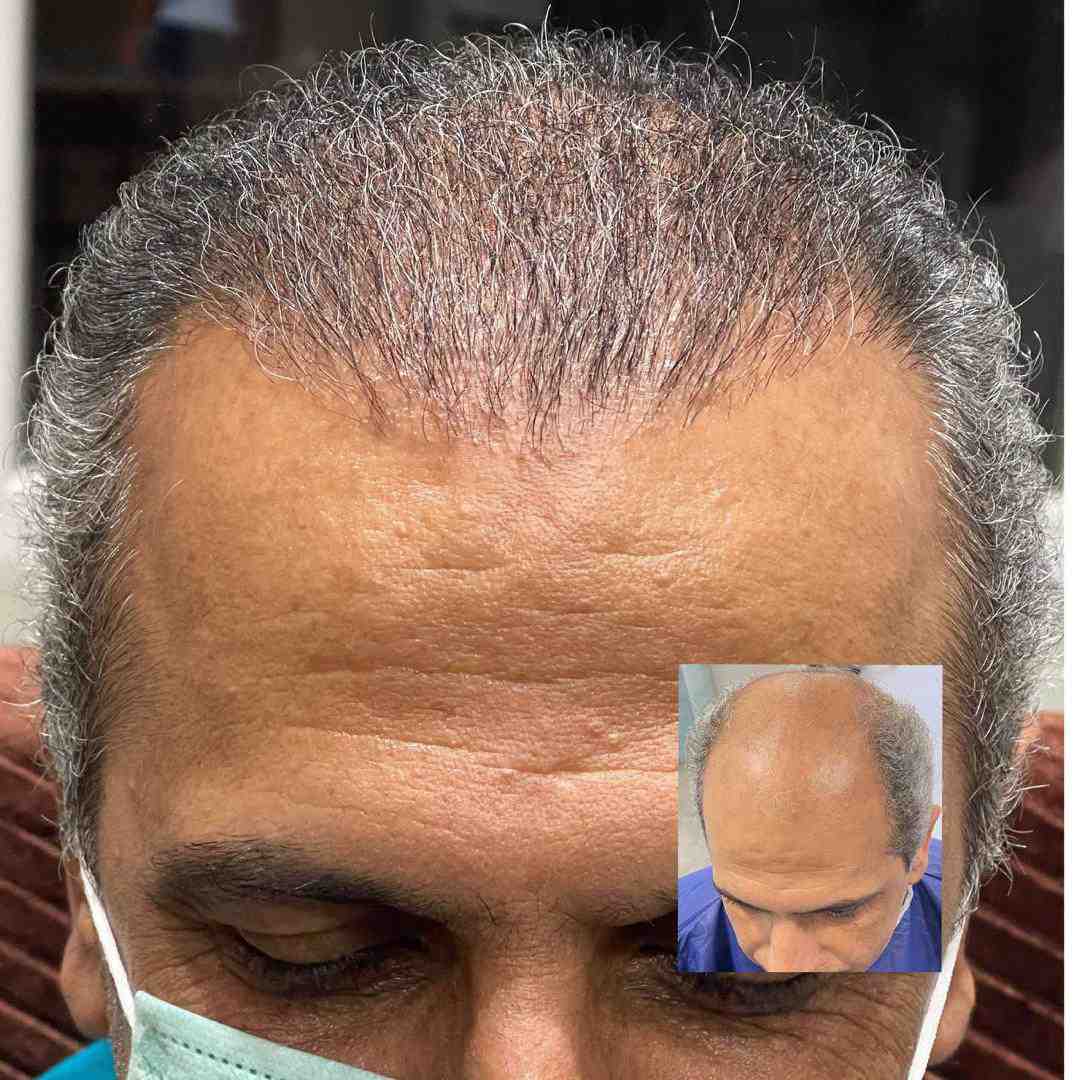خدمات کاشت مو و ابرو